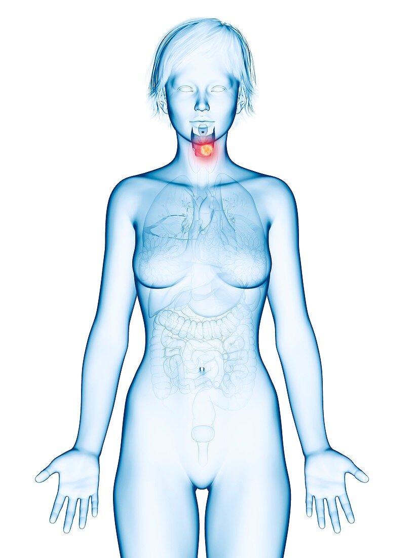 Illustration of larynx cancer