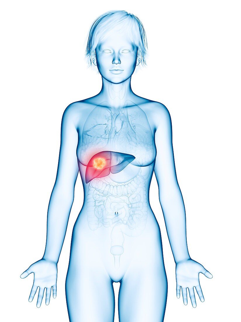 Illustration of liver cancer