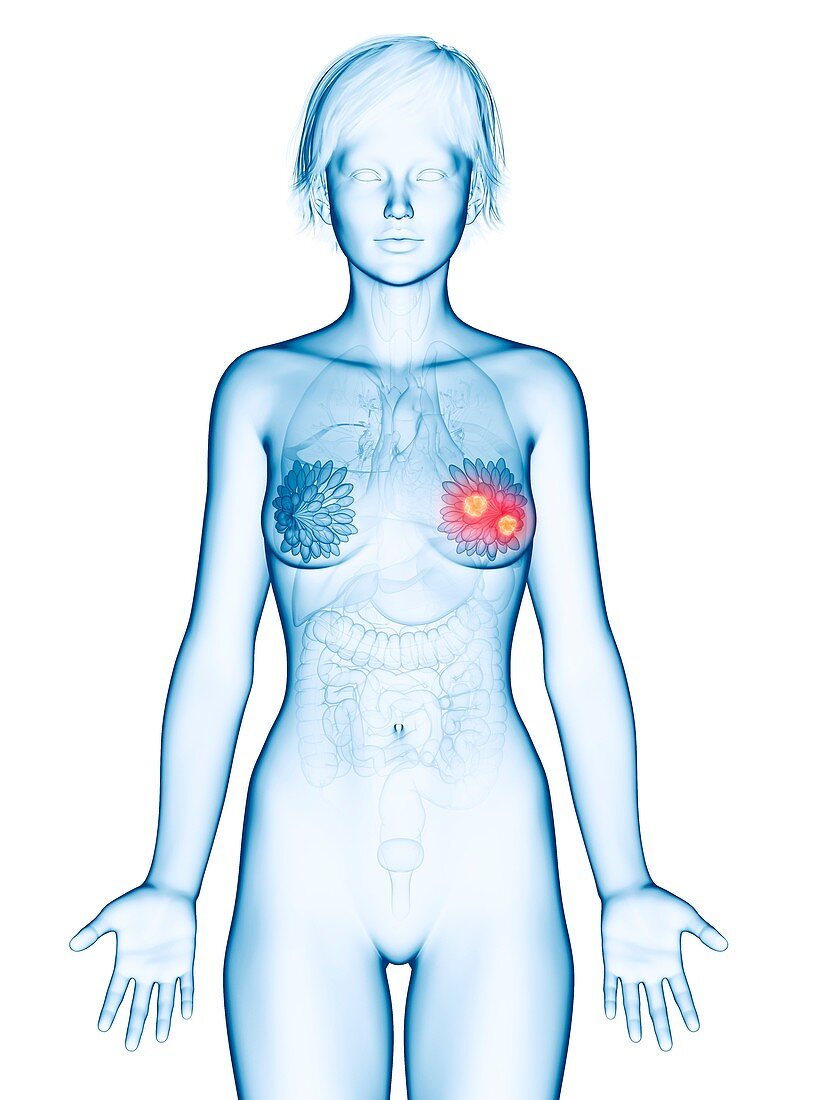 Illustration of mammary glands cancer