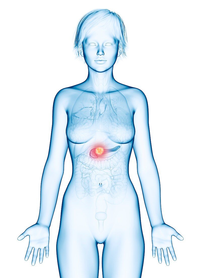 Illustration of pancreas cancer