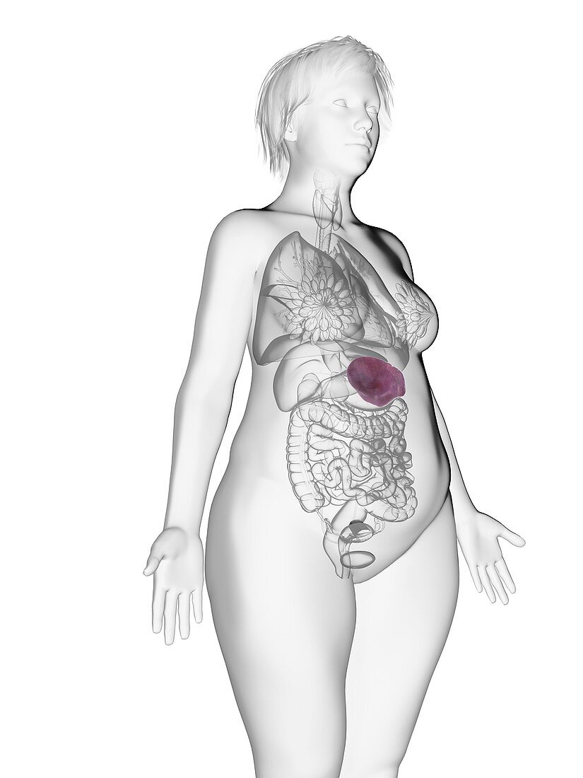 Illustration of an obese woman's spleen