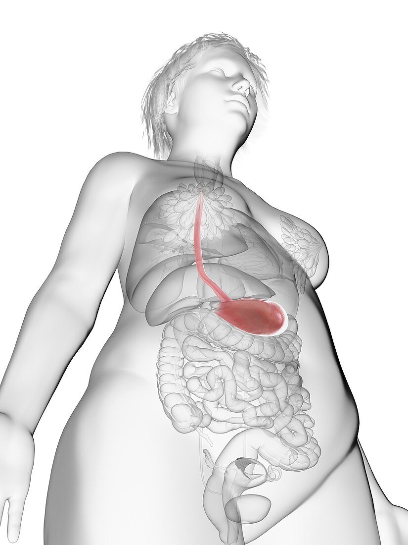 Illustration of an obese woman's stomach