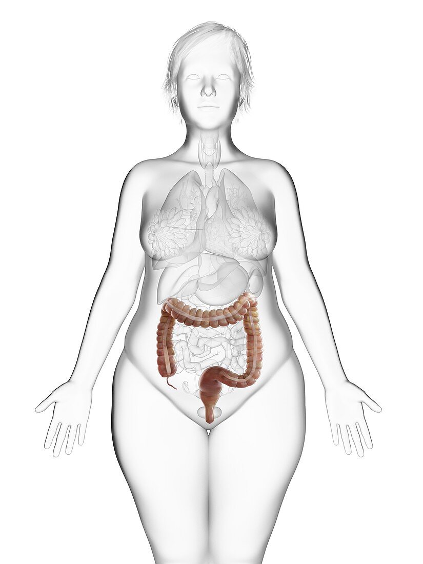 Illustration of an obese woman's colon