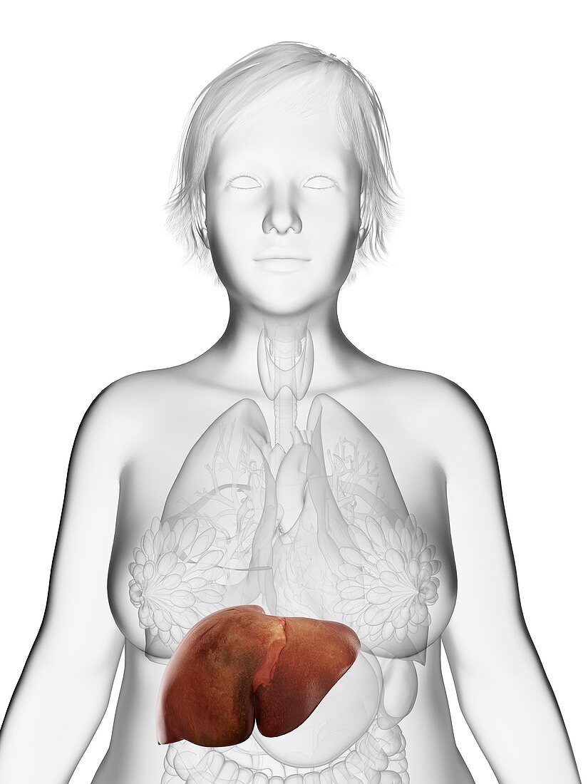 Illustration of an obese woman's liver