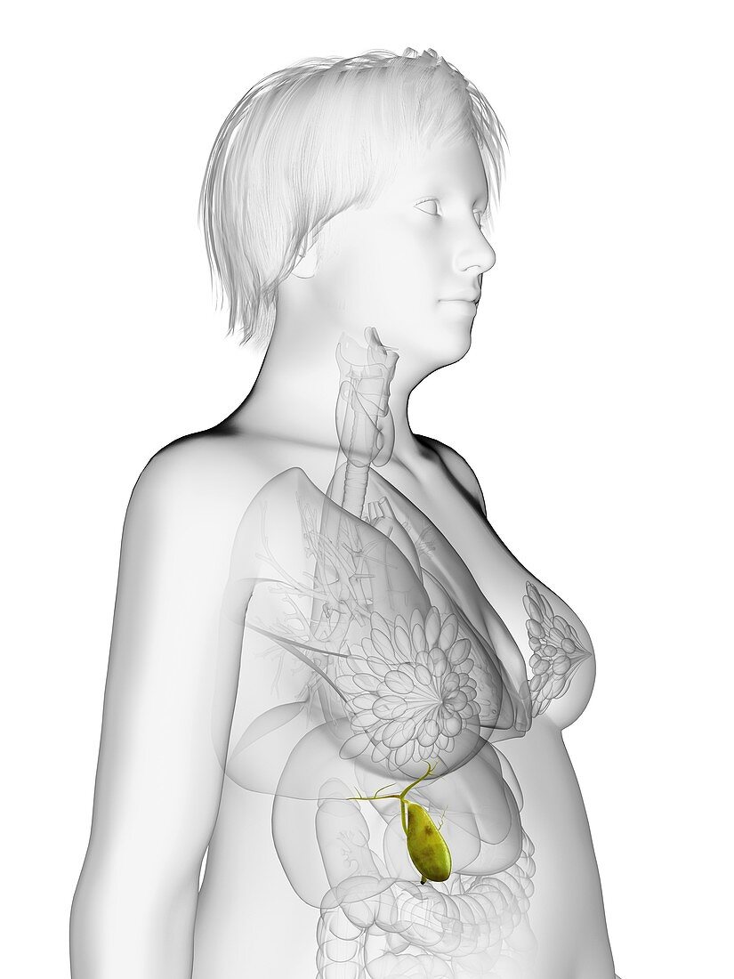 Illustration of an obese woman's gallbladder