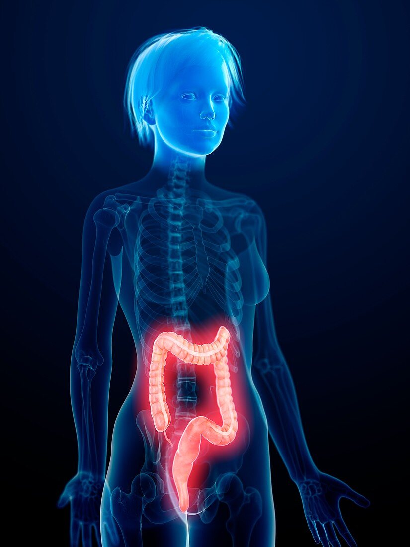 Illustration of an inflamed colon