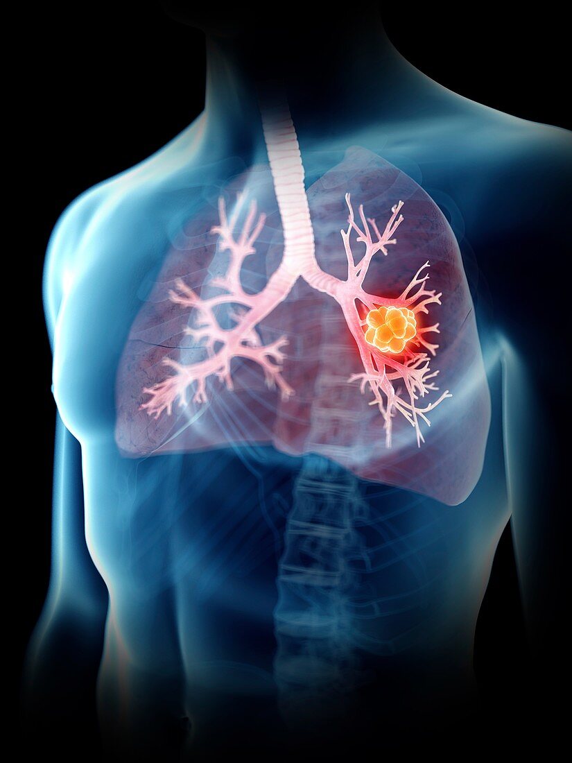 Illustration of a man's lung tumour