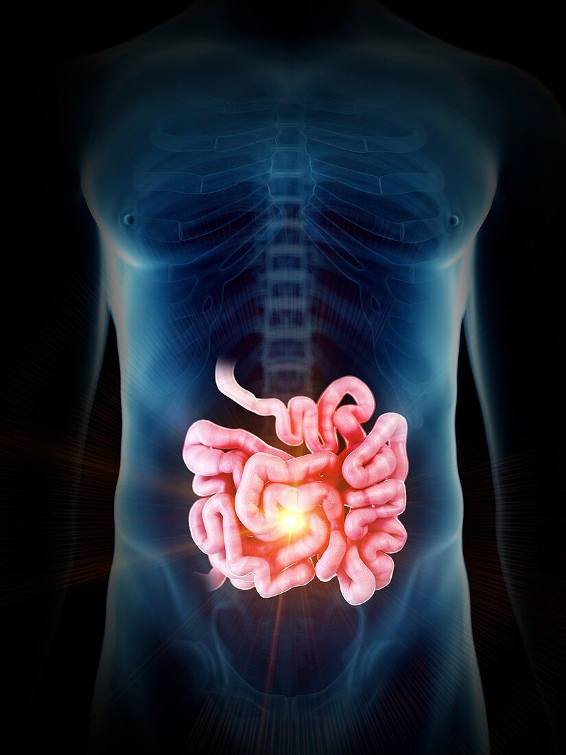 Illustration of a painful small intestine