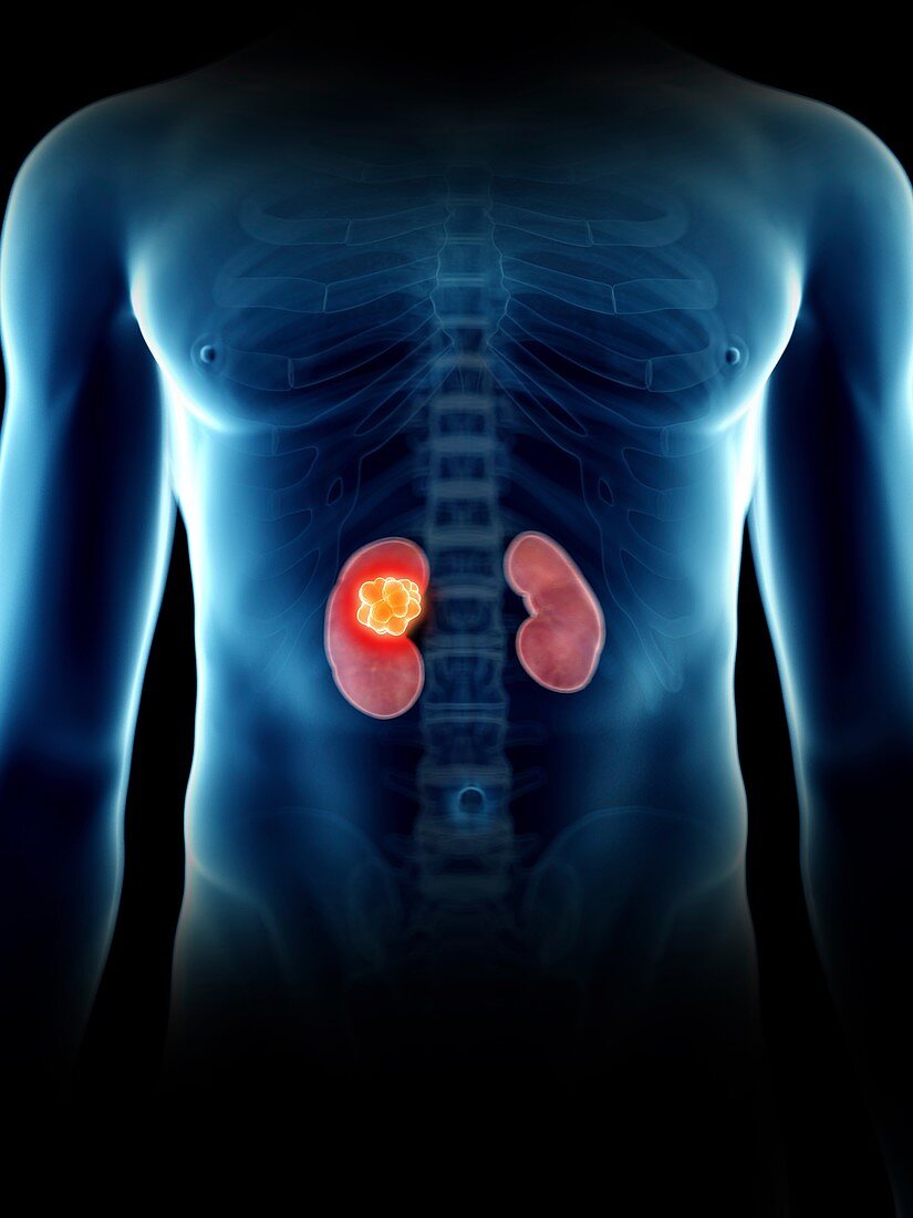 Illustration of a man's kidney tumour