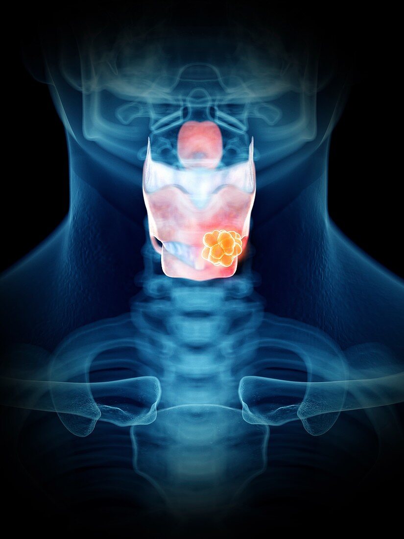 Illustration of a man's larynx tumour