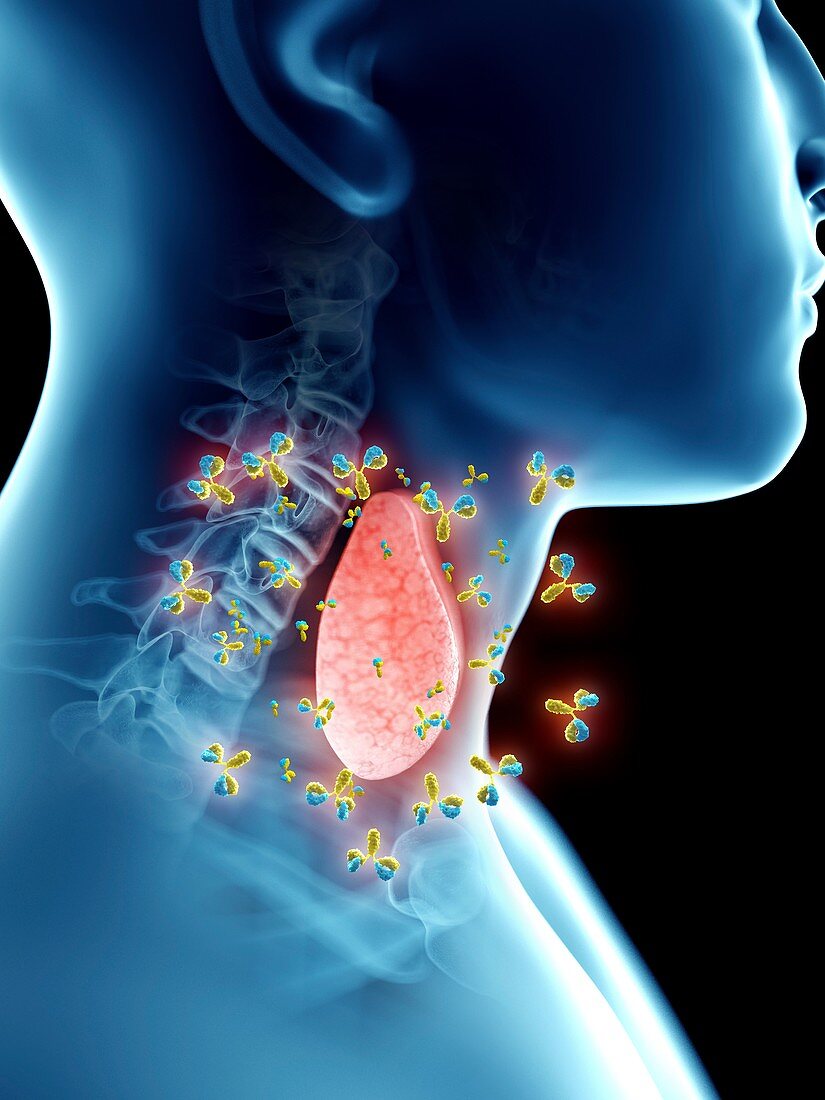 Illustration of autoimmune thyroid disease