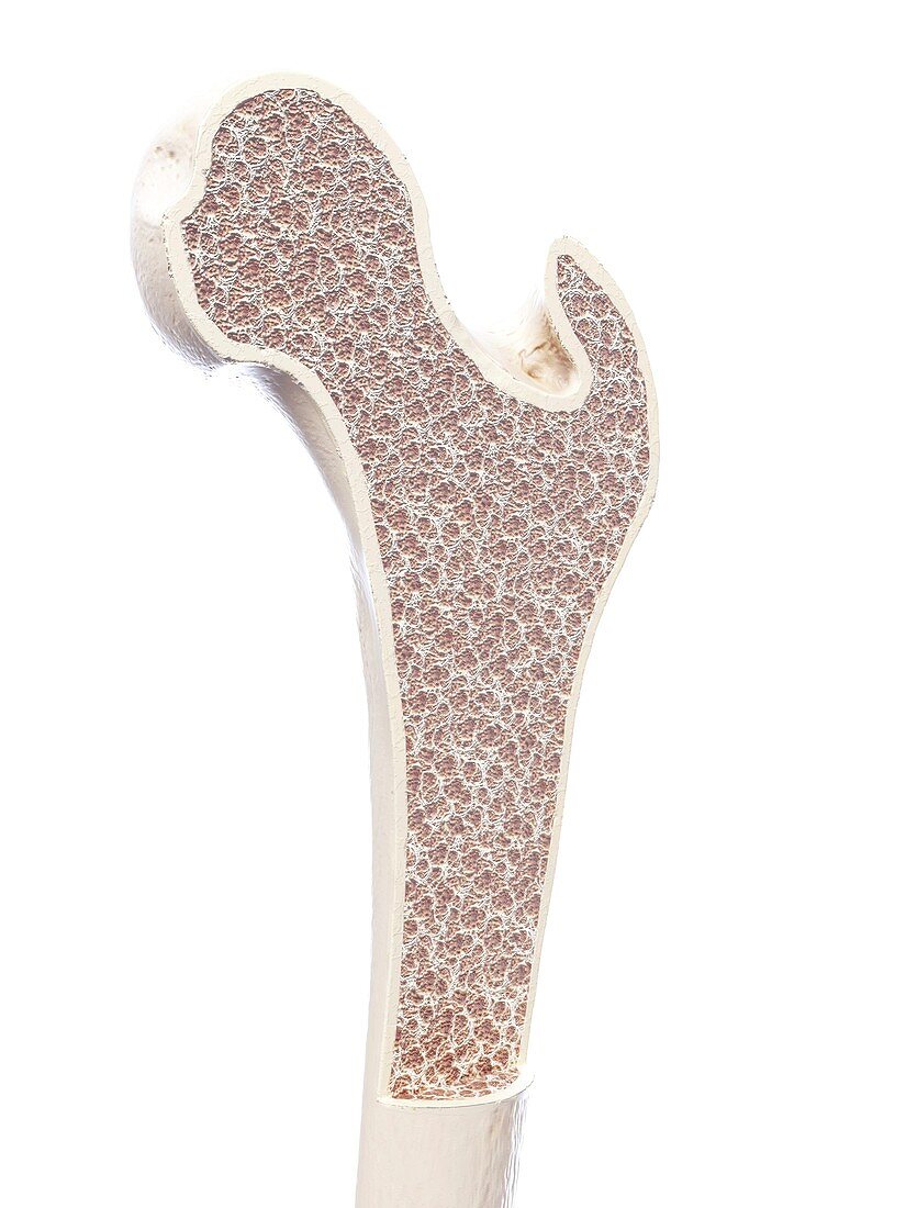 Illustration of osteoporosis