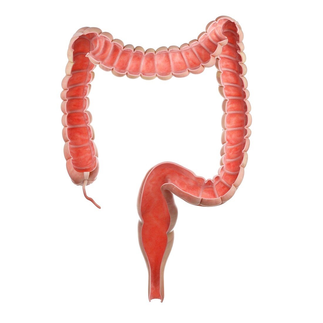 Illustration of a tumour in the rectum