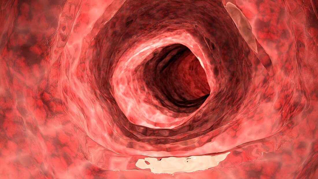 Illustration of an inflamed colon