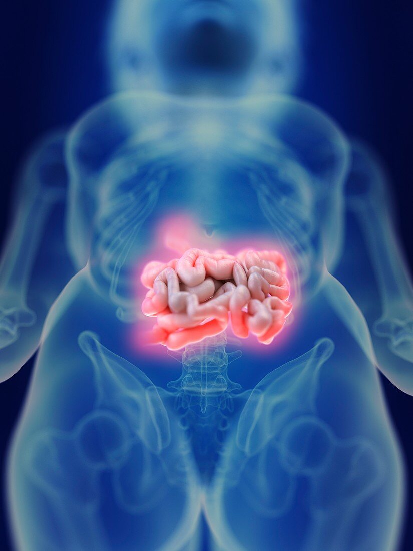 Illustration of an inflamed intestine