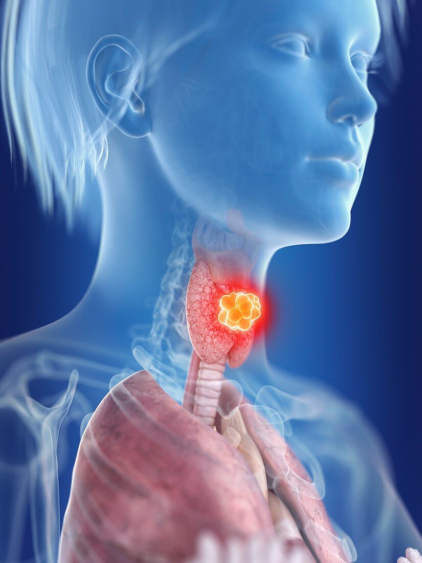 Illustration of a woman's thyroid gland cancer