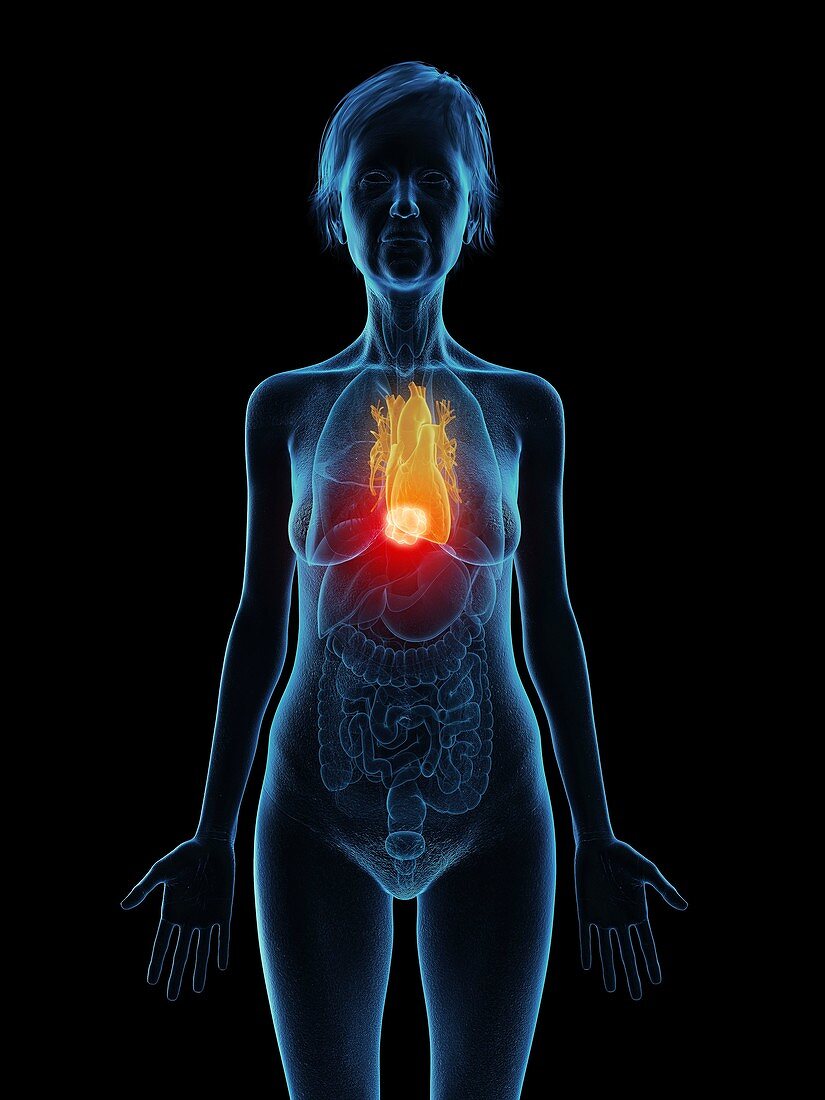 Illustration of an old woman's heart tumour