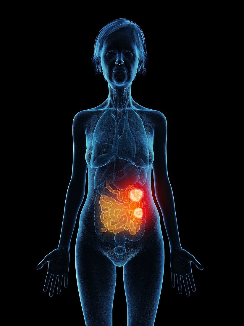 Illustration of an old woman's small intestine tumour