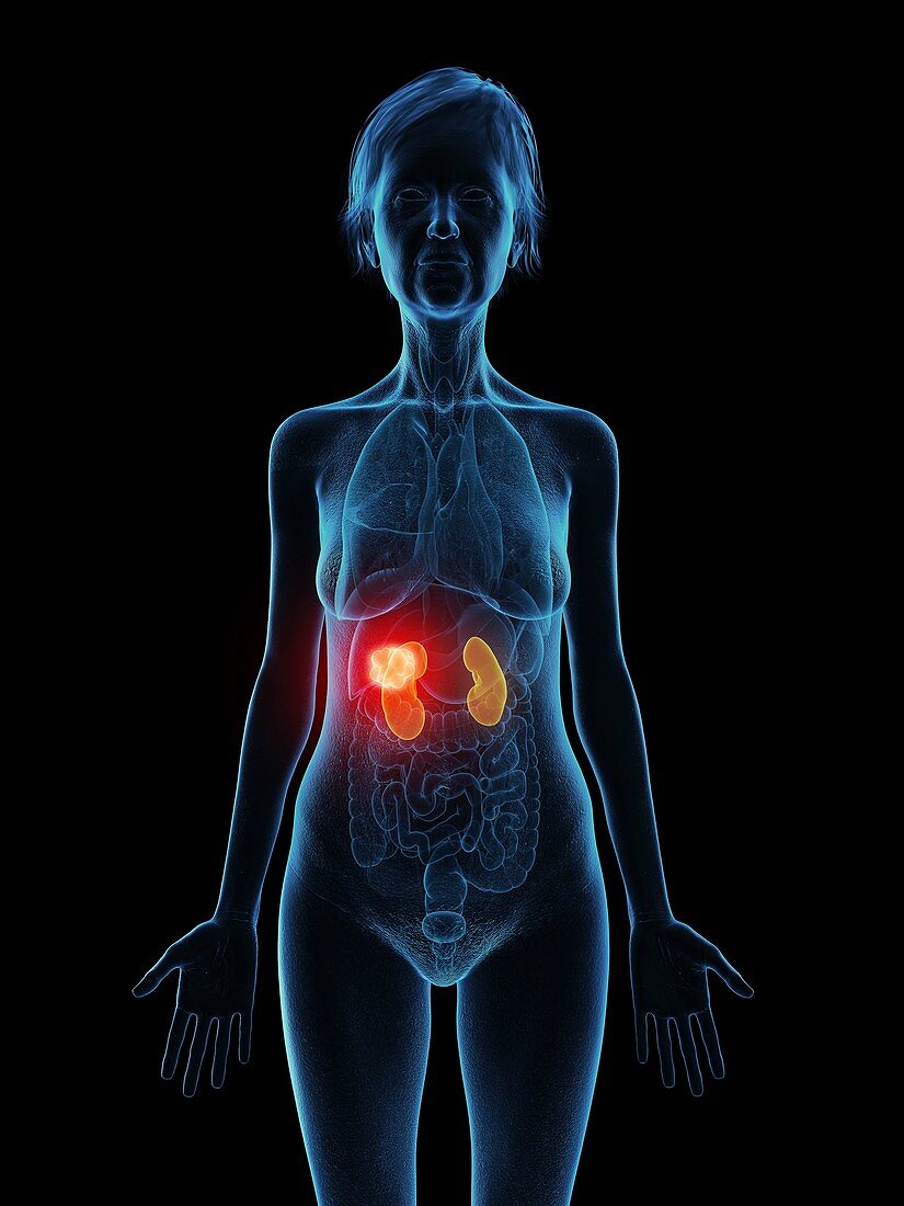 Illustration of an old woman's kidneys tumour