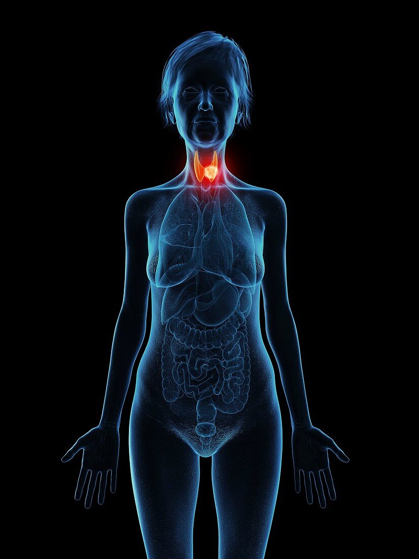 Illustration of an old woman's thyroid gland tumour