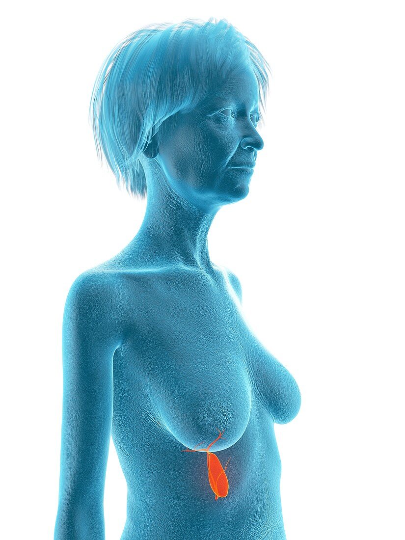 Illustration of an old woman's gallbladder