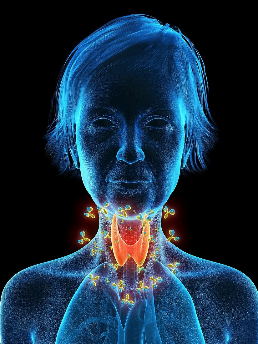 Illustration of an autoimmune thyroid disease