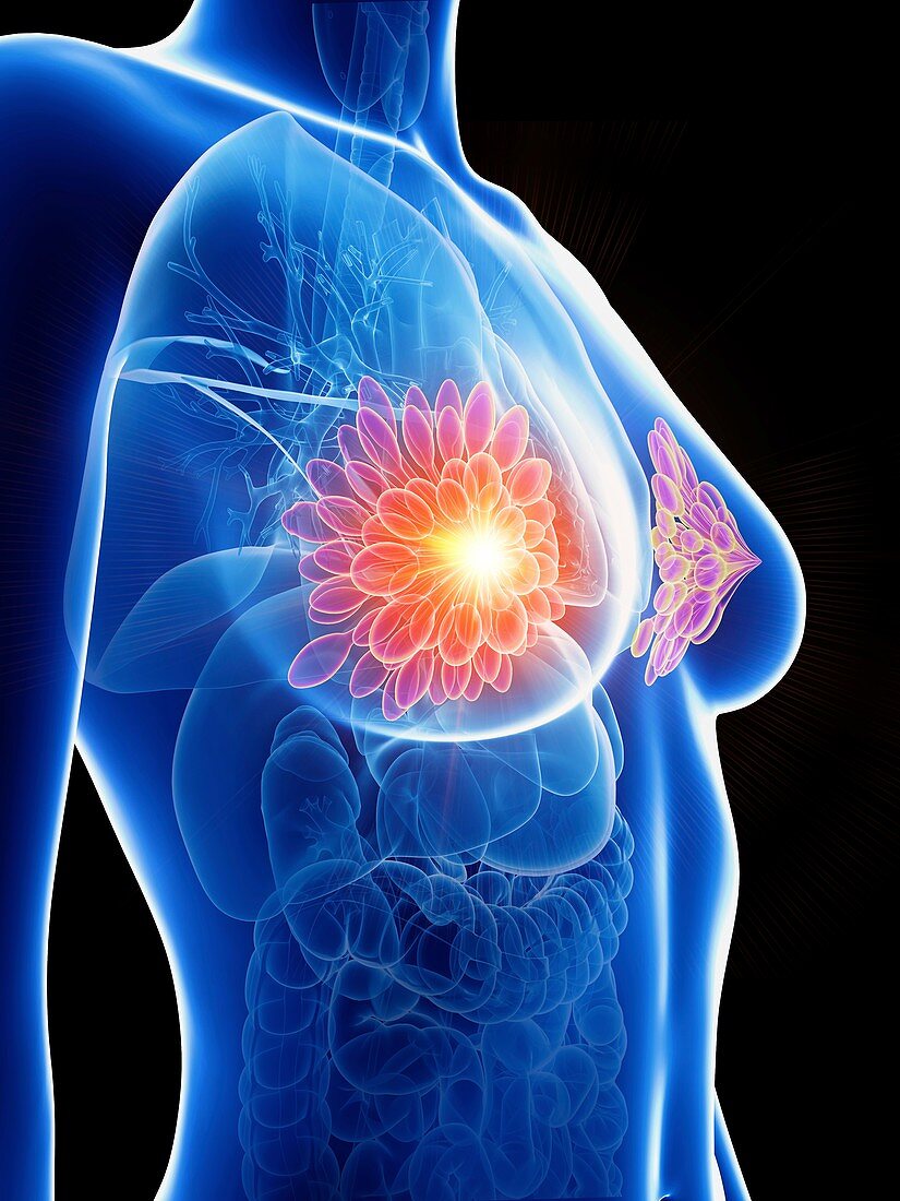 Illustration of a woman's inflamed mammary glands