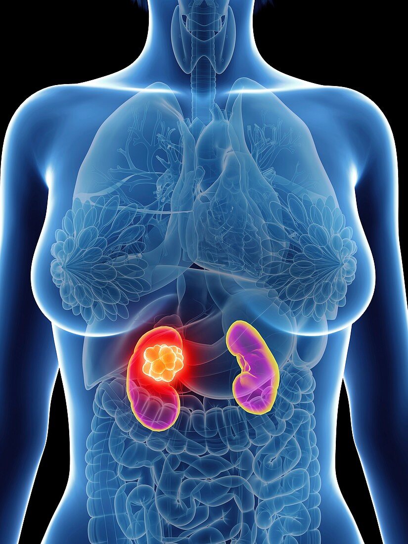 Illustration of a woman's kidneys cancer