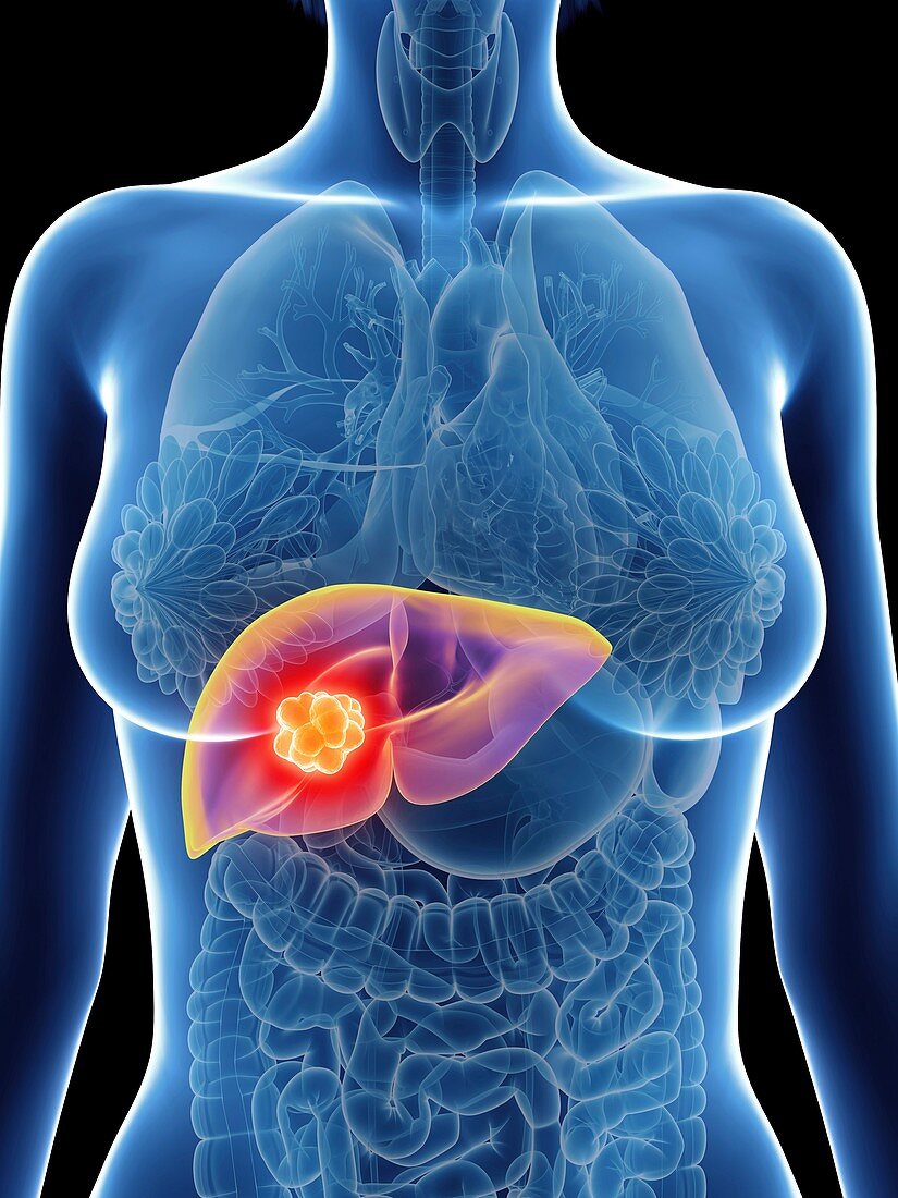 Illustration of a woman's liver cancer