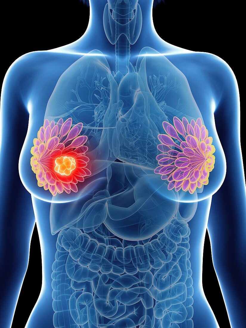 Illustration of a woman's mammary glands cancer