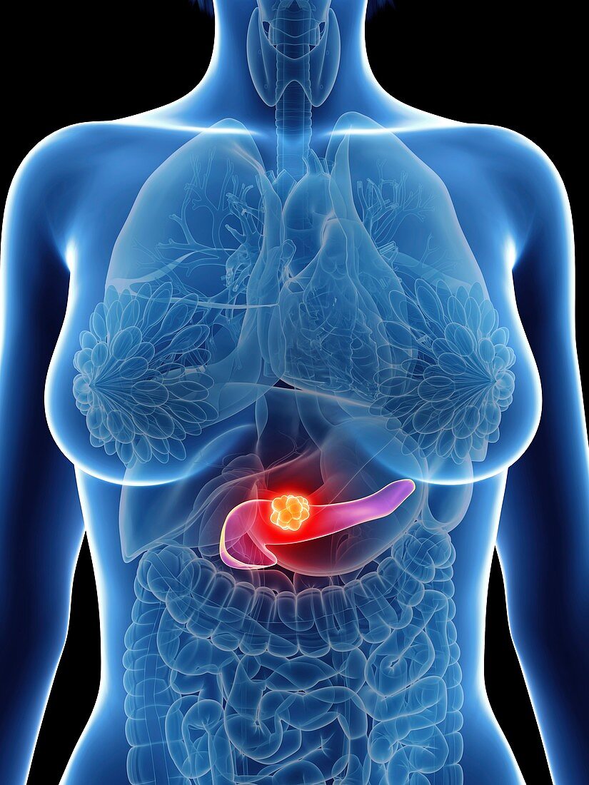 Illustration of a woman's pancreas cancer