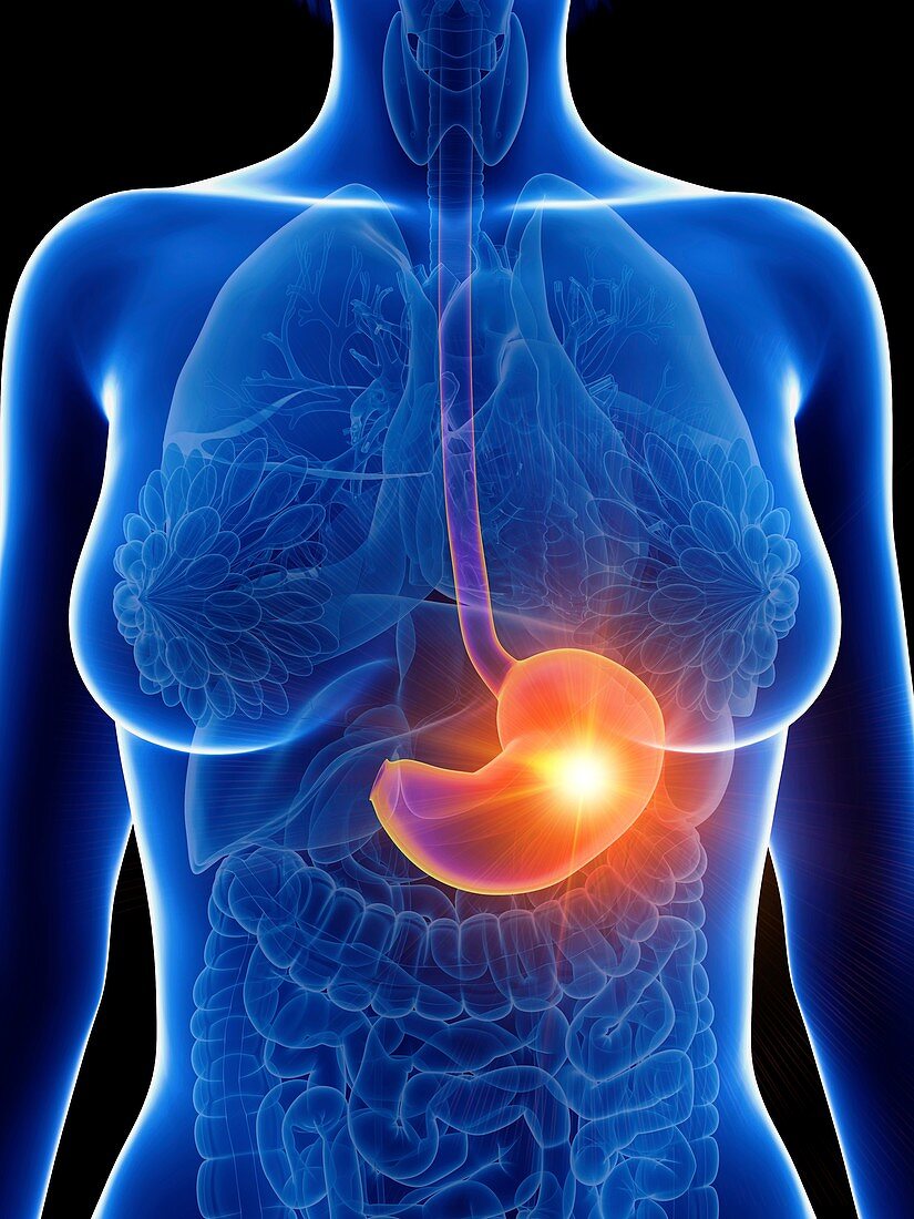 Illustration of a woman's inflamed stomach