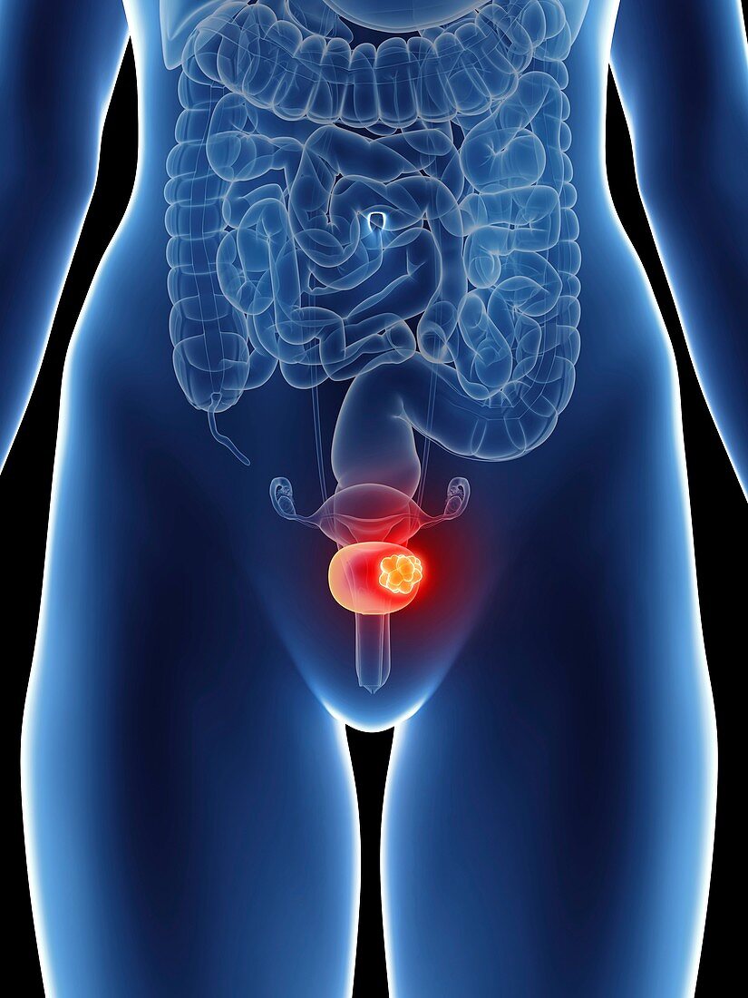 Illustration of a woman's bladder cancer