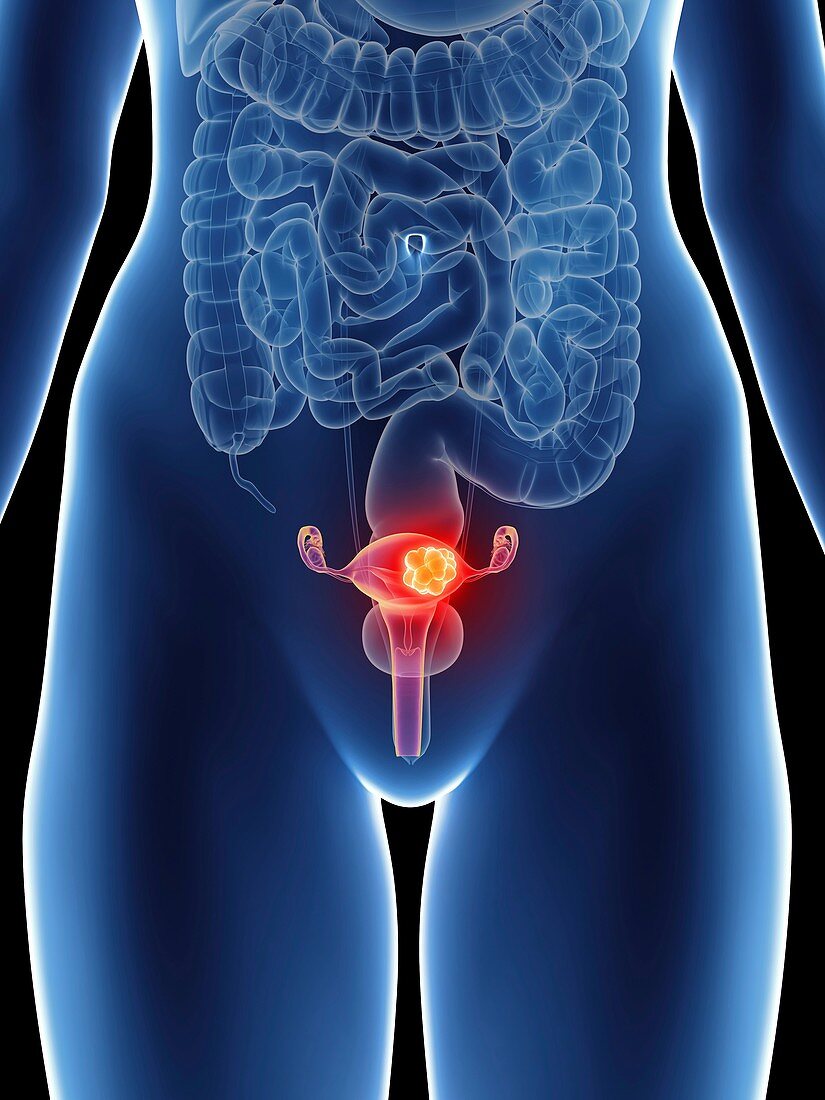 Illustration of a woman's uterus cancer