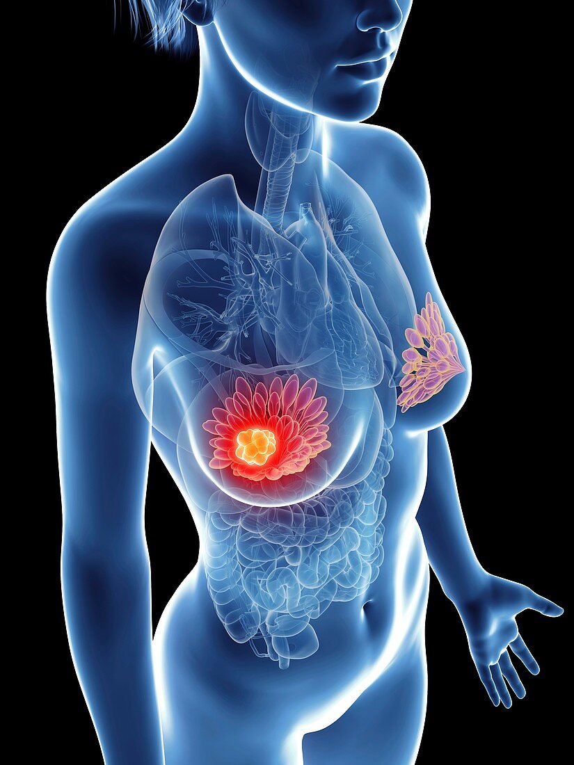 Illustration of a woman's mammary glands cancer