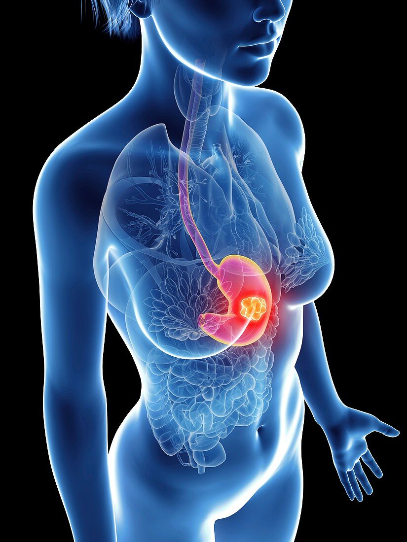 Illustration of a woman's stomach cancer