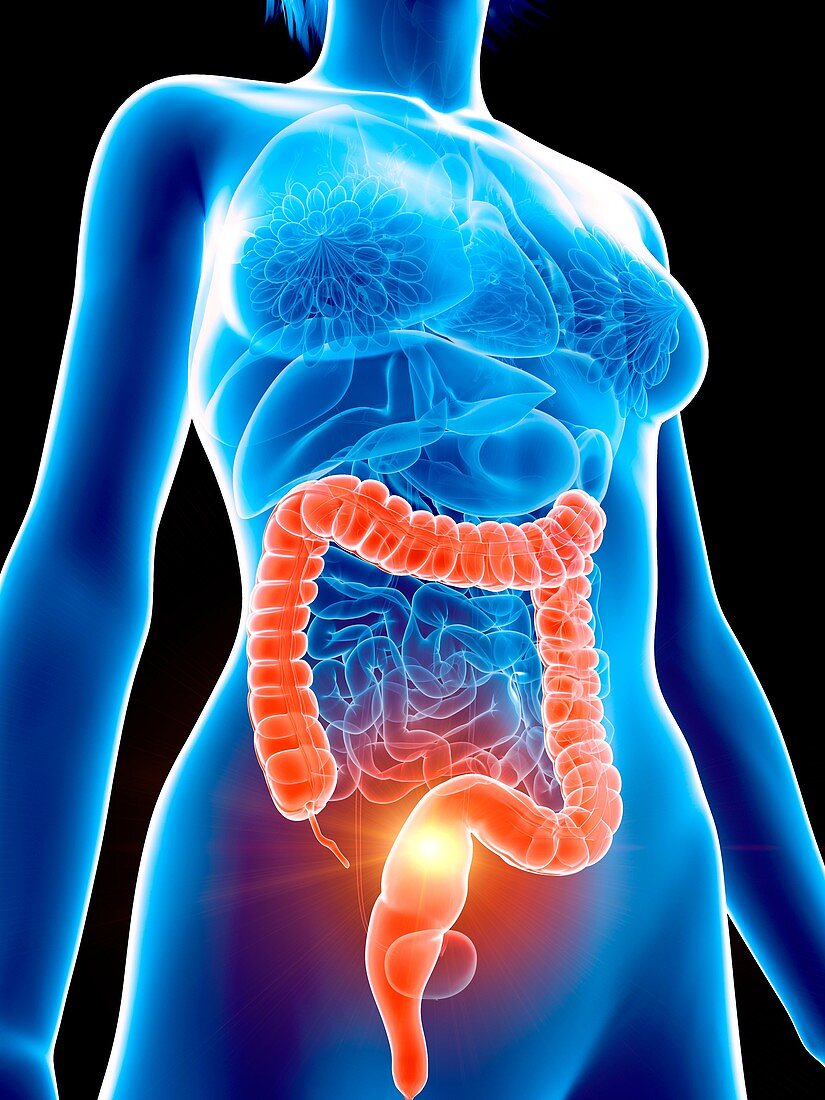 Illustration of a woman's painful colon