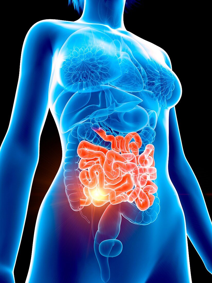 Illustration of a painful intestine