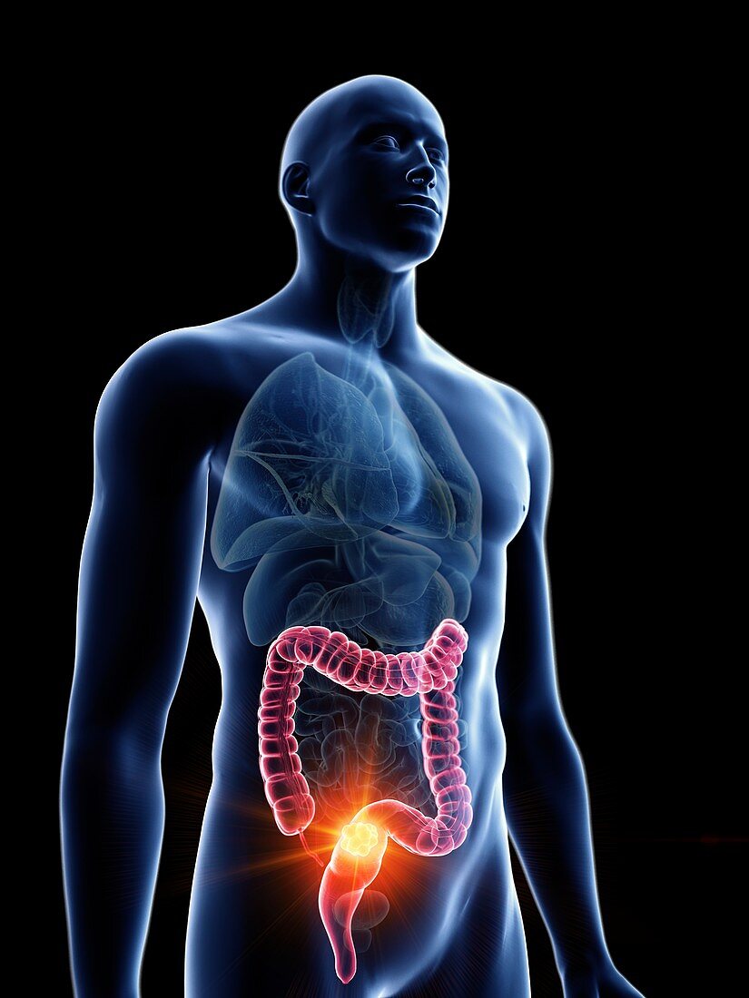 Illustration of a man's colon tumour