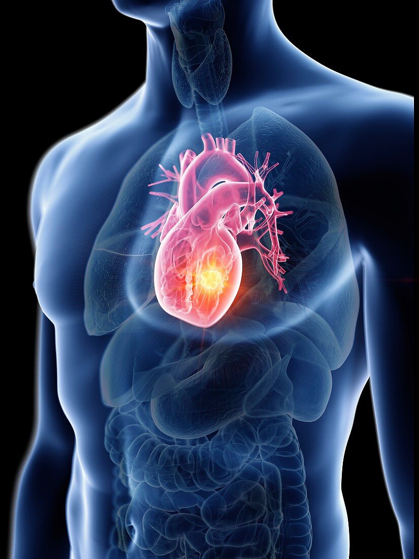 Illustration of a man's heart tumour