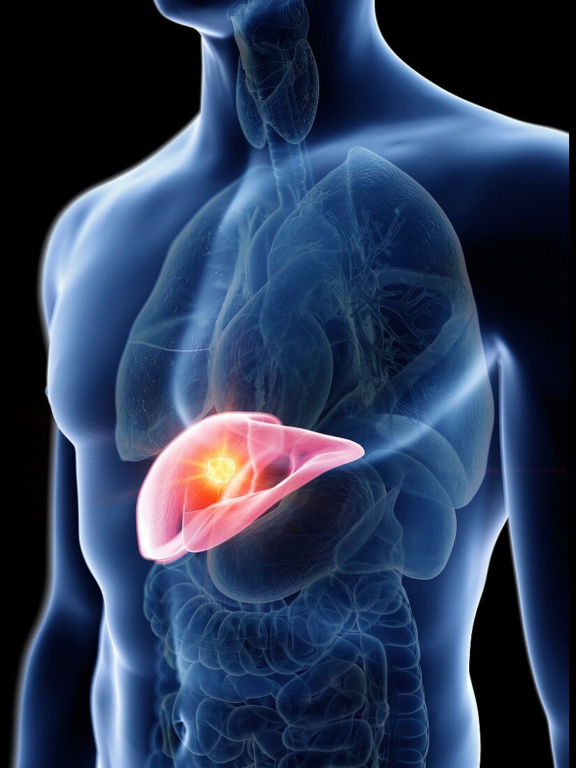 Illustration of a man's liver tumour