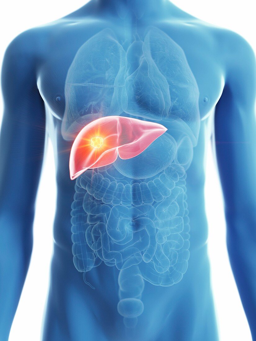 Illustration of a man's liver cancer