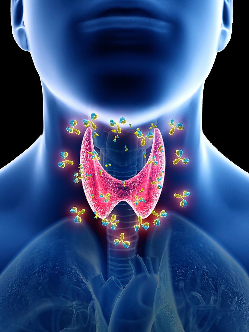 Illustration of autoimmune thyroid disease