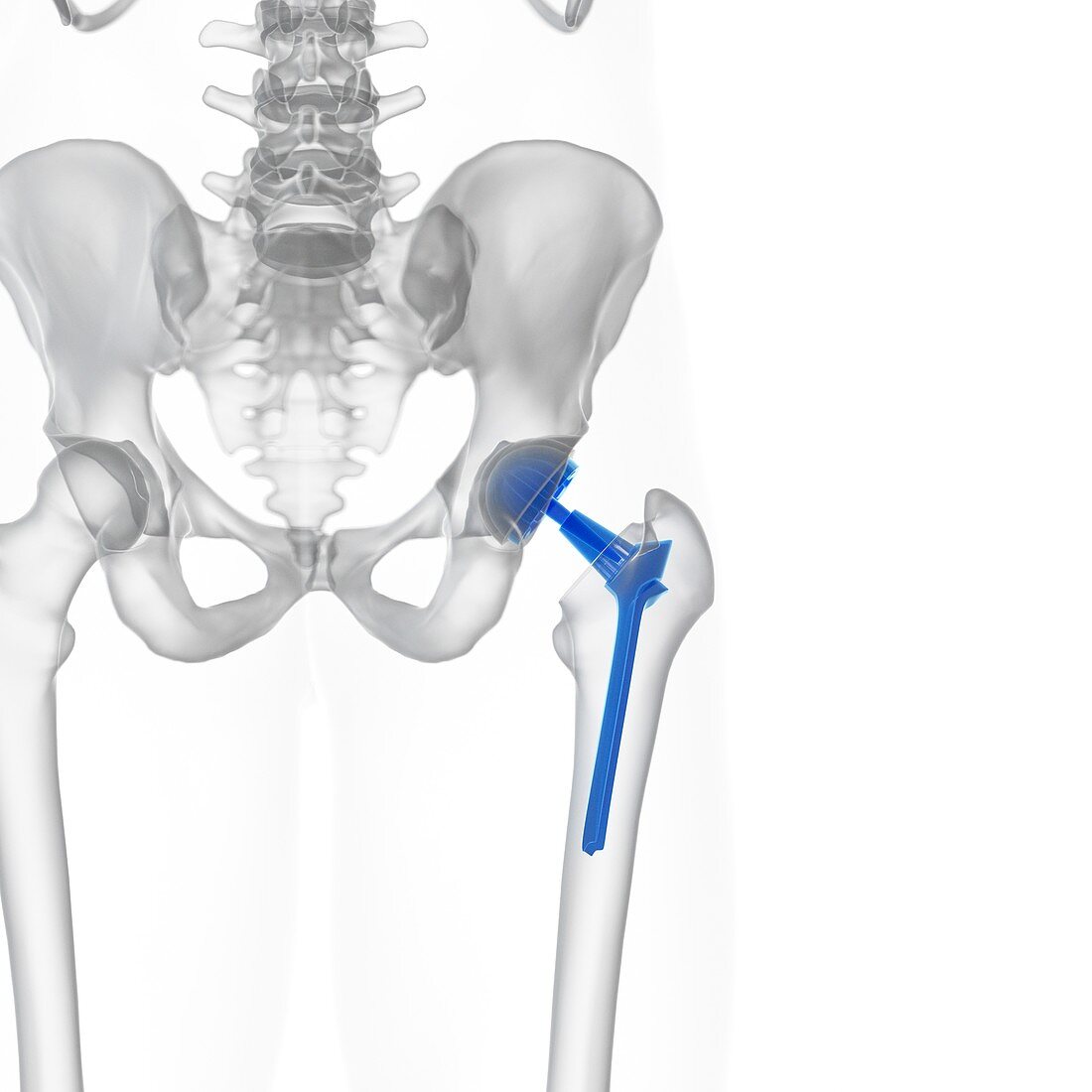 Illustration of a hip replacement