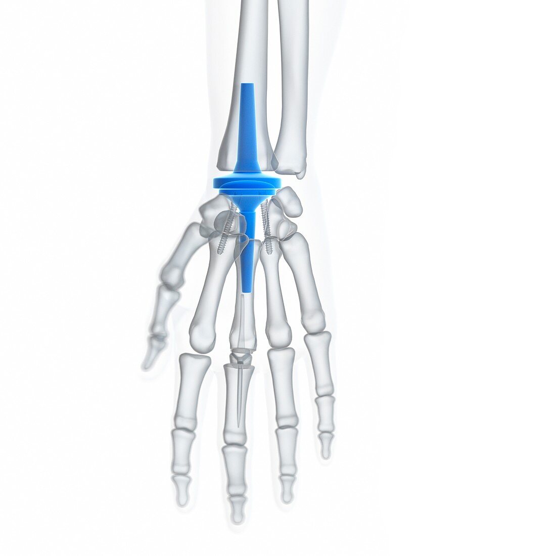 Illustration of a wrist replacement