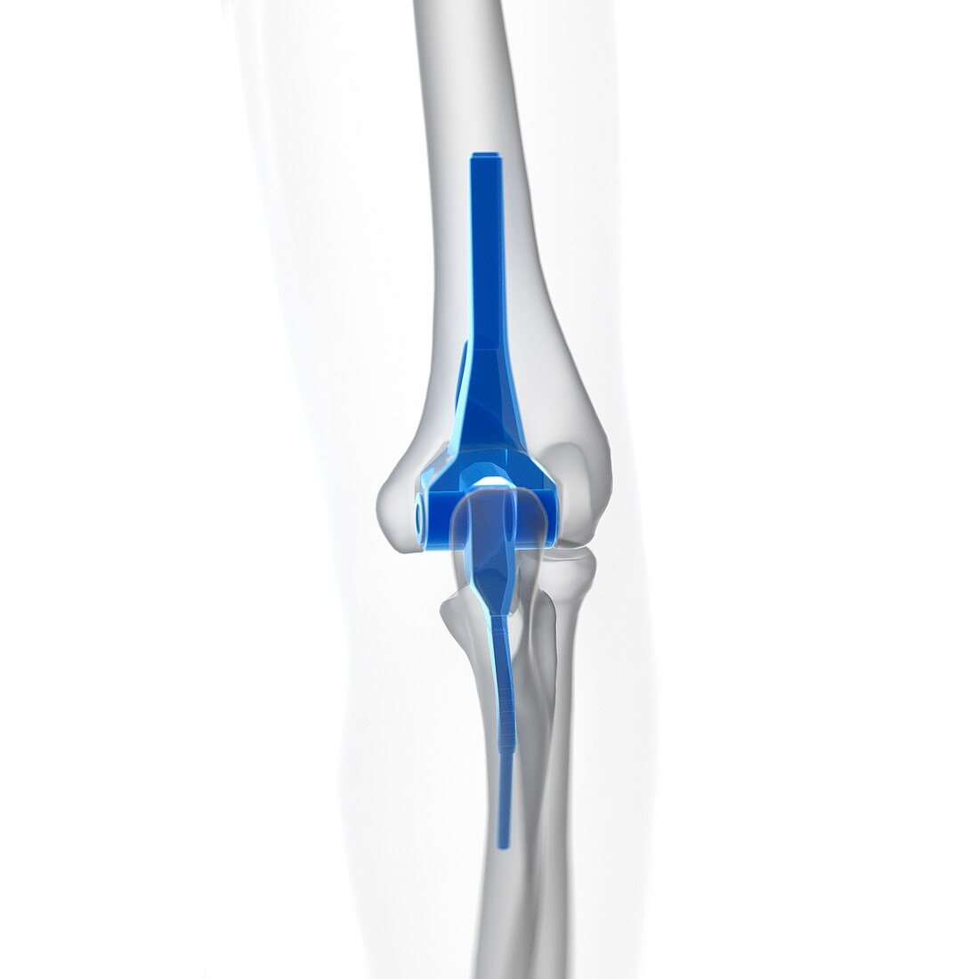 Illustration of an elbow replacement