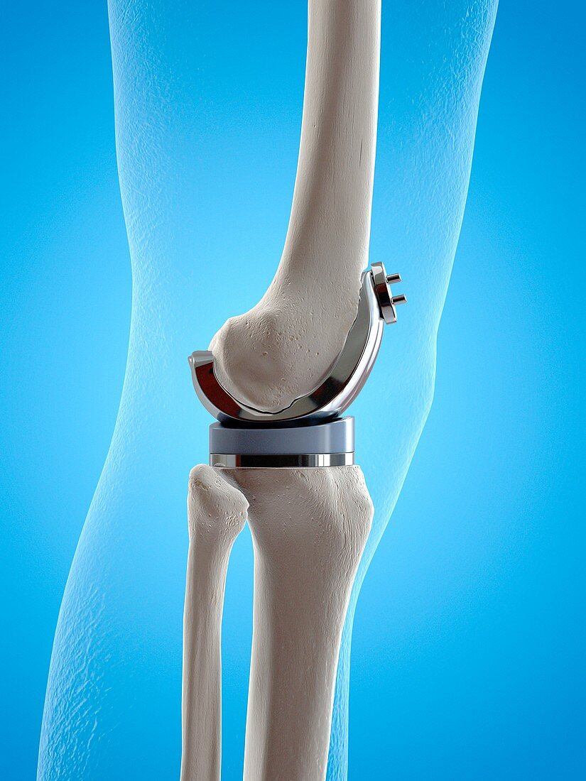 Illustration of a knee replacement