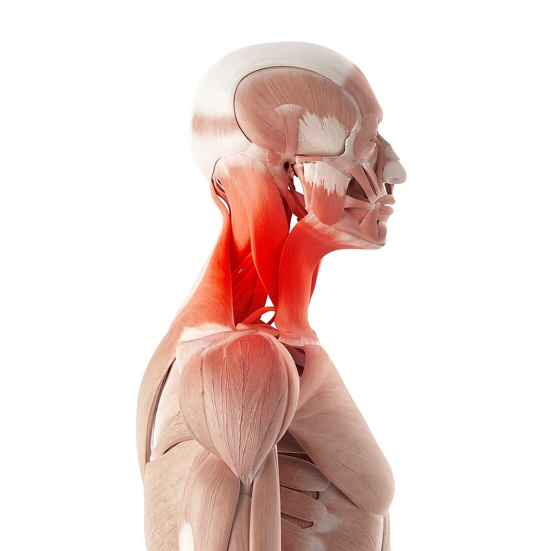 Illustration of painful neck muscles