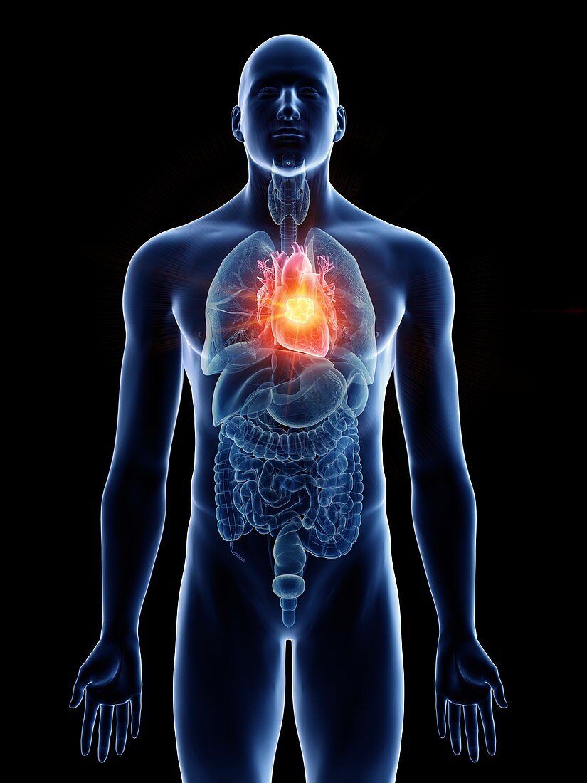 Illustration of a man's heart tumour