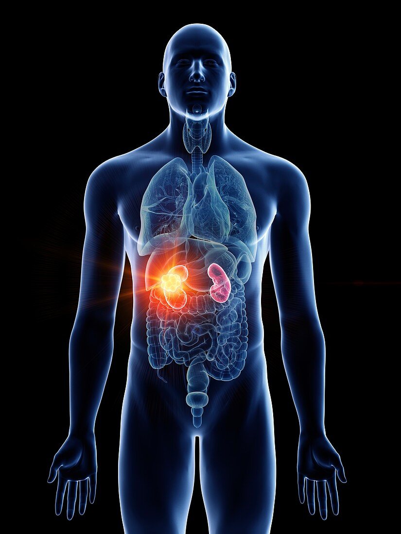 Illustration of a man's kidney cancer
